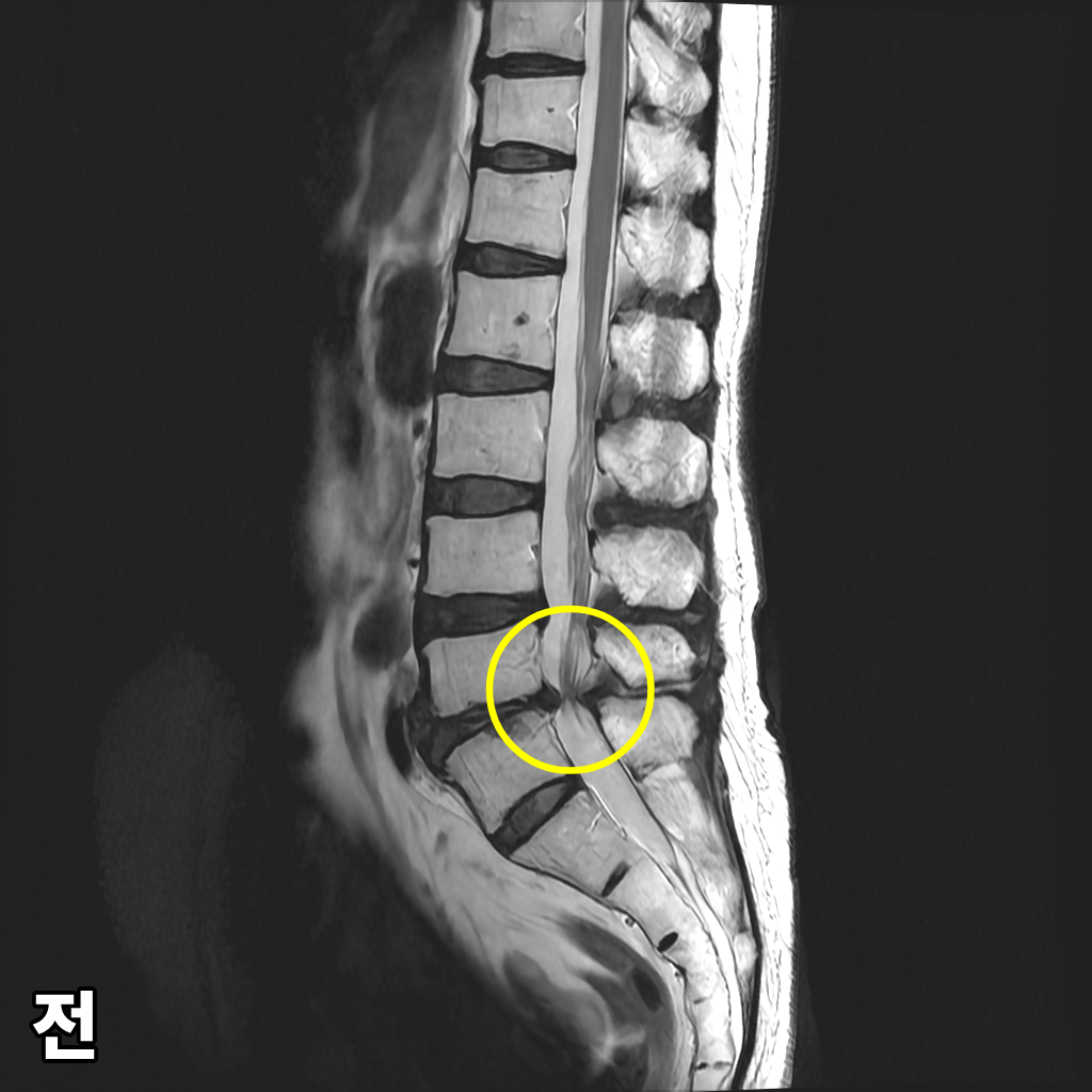 요추 내시경 시술 전 이미지